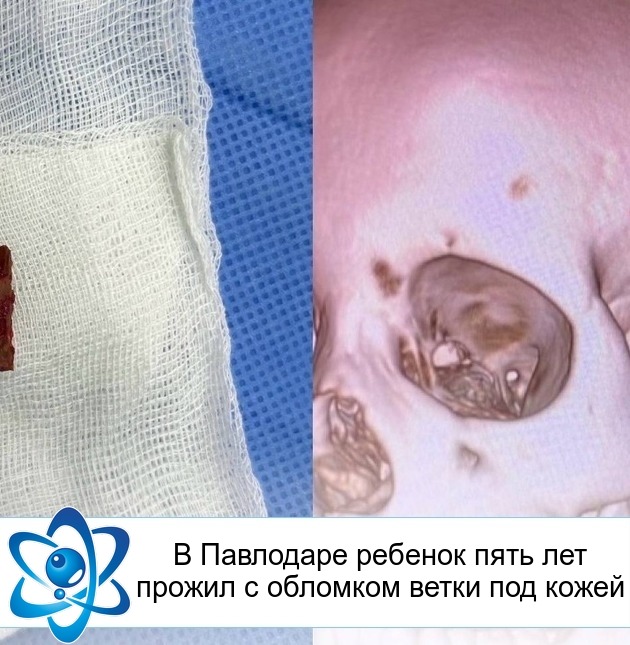 В Павлодаре ребенок пять лет прожил с обломком ветки под кожей